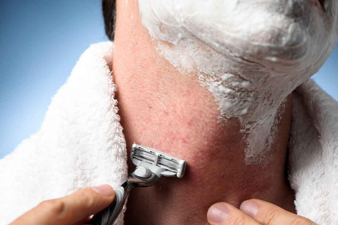 How Long Do Razor Bumps Last?