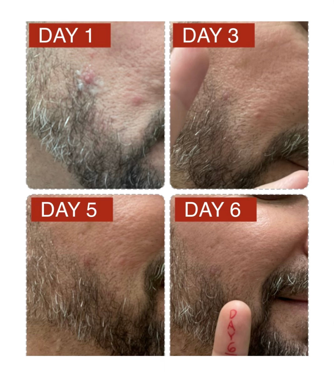 Pimple Spotter Emergency Medicated Pimple Eliminator Benzoyl Peroxide Power 1 oz/28.35 g